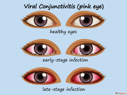 Clear Your Eyes with Homeopathic Conjunctivitis Treatment