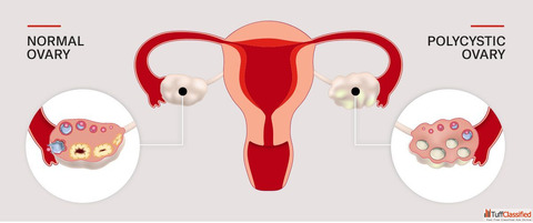 Homeopathy Care for PCOS Balance Your Hormones Naturally