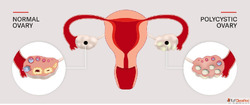 Homeopathy Care for PCOS Balance Your Hormones Naturally