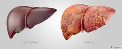 Early Signs of Liver Cancer You Should Know