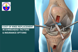 Are you looking for the cost of knee replacement in Ahmedaba...