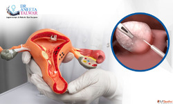 Best Myomectomy Surgery in Whitefield by Dr. Aneeta Talwar