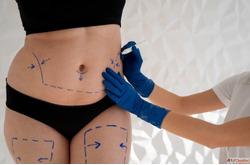Liposuction Treatment in Ahmedabad Safe Effective Fat Remova...