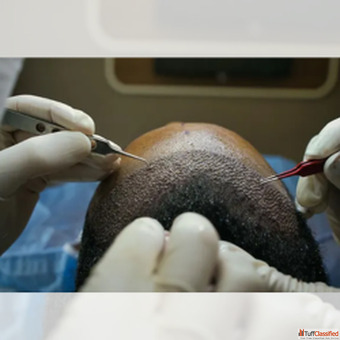 Advanced FUE Hair Transplant in Lucknow