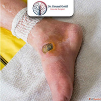 Best Diabetic Foot Treatment in Ahmedabad India for Long-Ter...