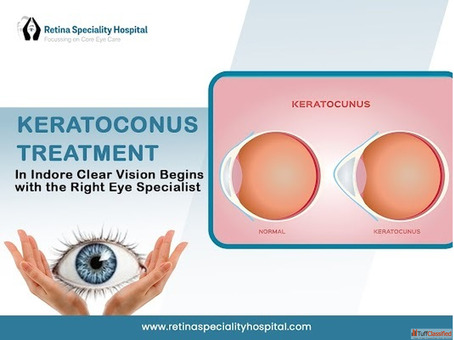Expert Keratoconus Treatment in Indore - Book Consultation Now