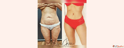 Tummy Tuck Surgery for Flat Belly That You Desire