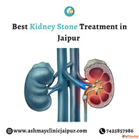 Best Kidney Stone Treatment in Jaipur - Get Relief Today