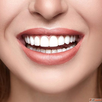 E-Max Veneers in Dubai