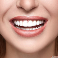 E-Max Veneers in Dubai