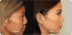 Book Your Dysport Consultation Today