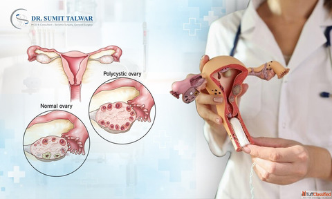 PCOS Care Bangalore - Sumitobesitycare