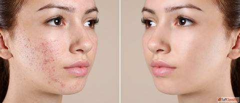 Acne Laser Treatment in Kingston Ontario