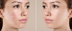 Acne Laser Treatment in Kingston Ontario