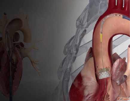 TAVR Surgery in Mumbai