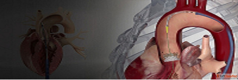TAVR Cost in India
