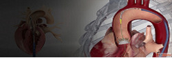 TAVR Cost in India