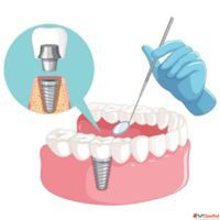 Safe Reliable Dental Implant Kolkata for Single or Multiple ...
