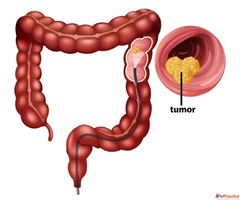 Expert Colon Cancer Treatment in AhmedabadDr Nitin Singhal