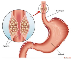 Expert Robotic Esophageal Cancer Surgeon in Ahmedabad for Pr...