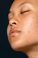 Trusted Homeopathy Doctor in Agra for Skin Pigmentation
