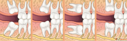 Wisdom Teeth Removal Adelaide