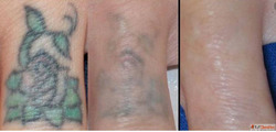 Remove Unwanted Tattoos Safely with Laser Tattoo Removal