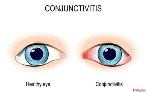 Healing Eyes with Homeopathic Treatment for Conjunctivitis