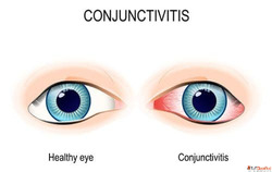 Healing Eyes with Homeopathic Treatment for Conjunctivitis