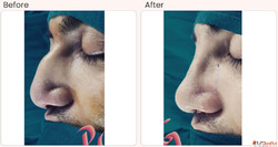 Rhinoplasty Surgery in Delhi - Dr Rajat Gupta