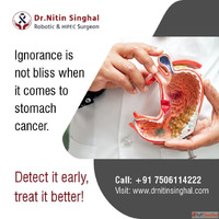 Expert Stomach Cancer Treatment in Ahmedabad by Dr. Nitin Si...