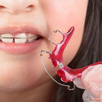 Teeth Retainers in Dubai