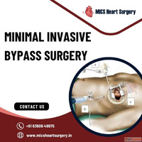 Minimally Invasive Bypass MIDCAB Surgery Bangalore