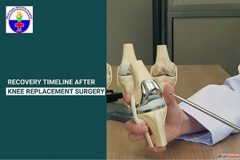 Recovery Timeline After Knee Replacement Surgery Step-by-Step Guide