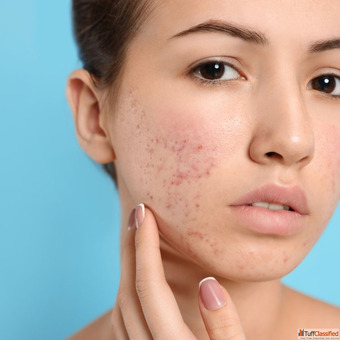 Transform Your Skin with Acne Scar Treatment in Andheri West