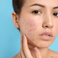 Transform Your Skin with Acne Scar Treatment in Andheri West