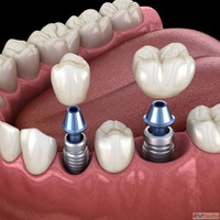 Dental Implants in Dubai
