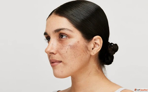 Top Skin Pigmentation Treatment with Homeopathy Dr. Ankur Prakash