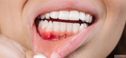 Homeopathic Treatment and Medicine for Mouth Ulcers in Agra
