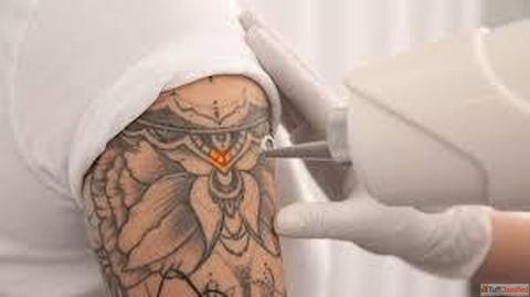 Everything You Need to Know About Permanent Tattoo Removal - Safe Effective Solutions
