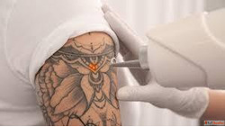 Everything You Need to Know About Permanent Tattoo Removal -...