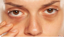 Dark Circle Removal Clinic in Delhi Bright Youthful Eyes