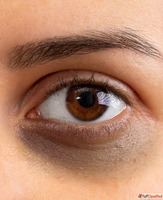 Dark Circle Treatment in Ghaziabad