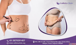 Liposuction in Surat - Callisto Clinic