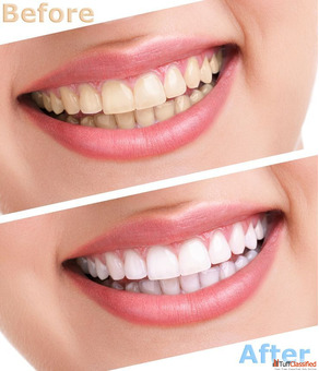 ToothFirstLife - Teeth whitening