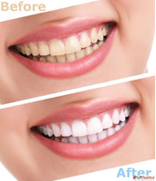 ToothFirstLife - Teeth whitening