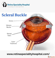 Affordable Scleral Buckle Treatment Indore - Retina Speciali...