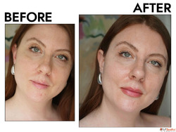 IPL Treatment in Kingston Ontario