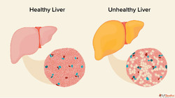 Treatment for Fatty Liver with Homeopathy Medicine