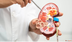 Say Goodbye to Kidney Stone Pain with Homeopathic Medicine